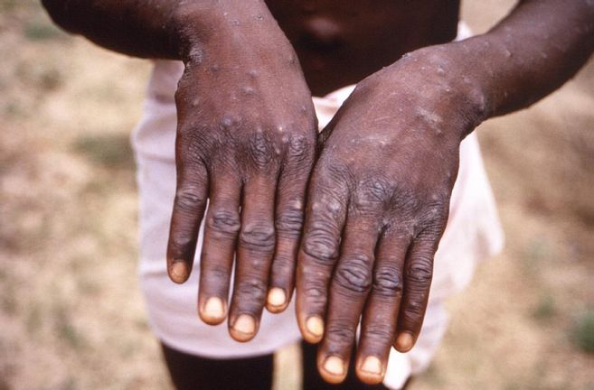 Participation à la Table ronde sur la problématique de la vaccination contre la Mpox dans le contexte du Congo